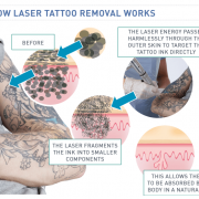 St Pete Tattoo Laser Tattoo Removal Aftercare