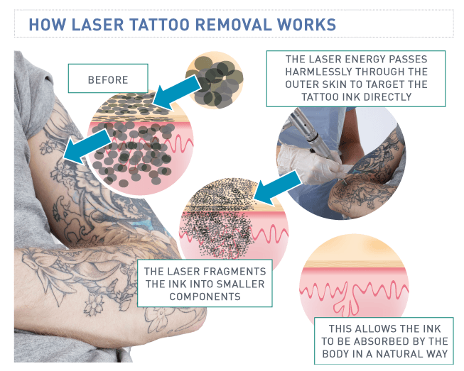 St Pete Tattoo Laser Tattoo Removal Aftercare - Black Amethyst Tattoo  Gallery